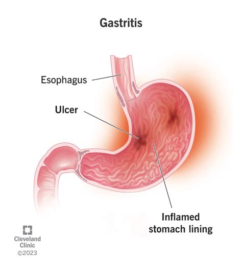 Understanding Gastritis: Causes, Symptoms, And Treatment - Ask The Nurse Expert