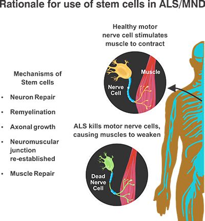 Motor Neuron Disease - Cell Therapy