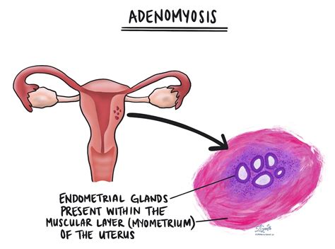 Adenomyosis | MyPathologyReport.ca