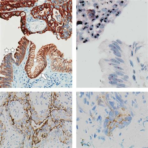 (PDF) HER2 testing in gastric cancer: A practical approach