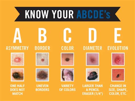 Skin Cancer Moles Chart