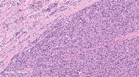 Pathology Outlines - Paraganglioma