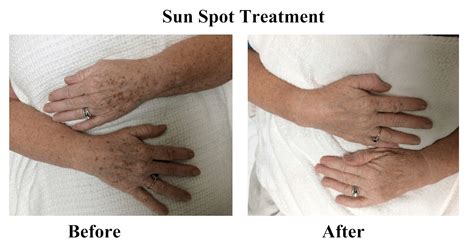 Age Spot Sun Spot Removal Raleigh | Skin Essence A Day Spa