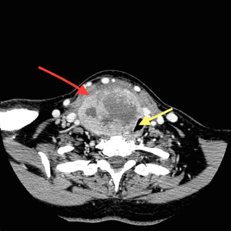 Anaplastic Thyroid Cancer Diagnosis