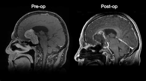 The remarkable case of a giant pituitary adenoma - Pituitary World News