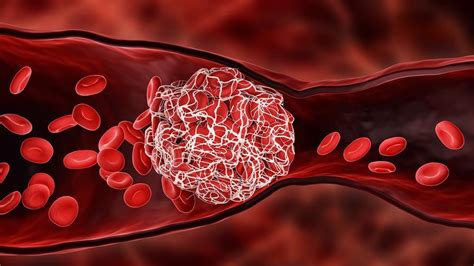 The Role of Blood Clot Sensors in Treatment and Diagnostics