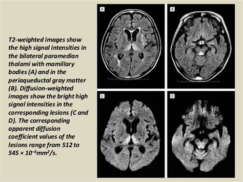 Presentation1, radiological imaging of wernicke encephalopathy.