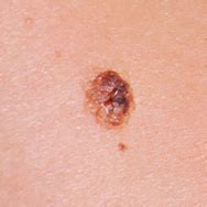 Risk Factors for Melanoma - The Dermatology of Institute of Boston