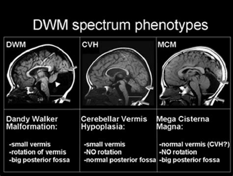 Dandy Walker Malformation Diagram