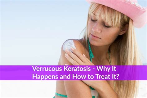 Verrucous Keratosis - Everything You Need to Know - The Healthy Apron