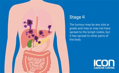 What is Soft Tissue Sarcoma? Soft Tissue Sarcoma Explained — Icon ...