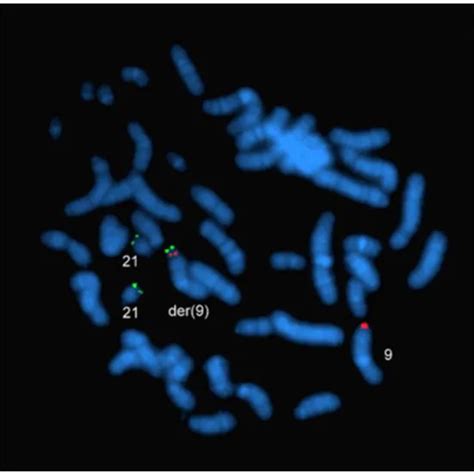 FISH, Prenatal Aneuploidy Detection-CVS (5 Probes- Trisomy 21,18,13; X,Y) Test | GDIC