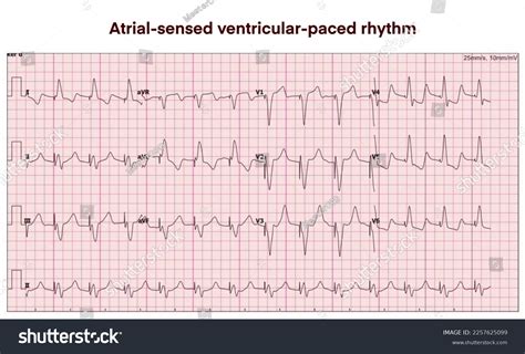 Electrocardiogram Show Atrial- Sensed Ventricular-paced Rhythmasvp Stock Illustration 2257625099 ...