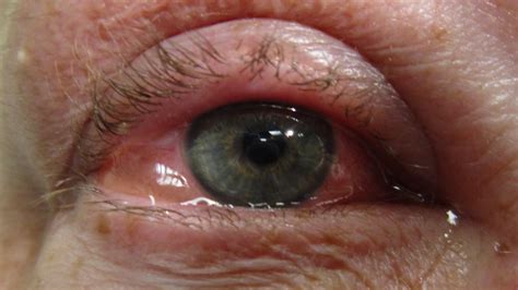 How well do you know Allergic Conjunctivitis