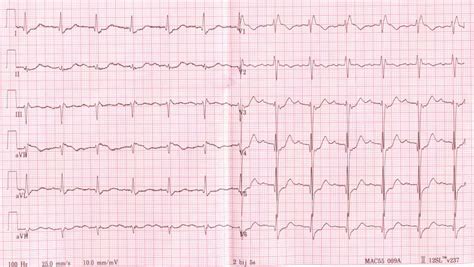 Abnormalities in the cardiac cycle. - WriteWork