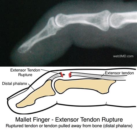 Mallet Finger