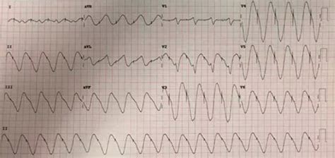 Dr. Smith's ECG Blog: Weakness and Dyspnea with a Sine Wave. It's not ...