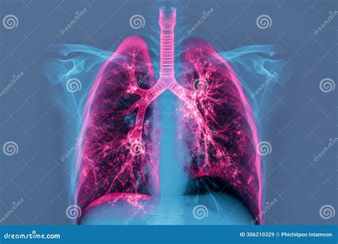 X-ray Human Lungs with Cystic Fibrosis, Medical Concept. Generative AI Stock Image - Image of ...