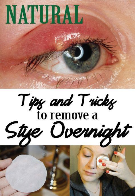 Natural Tips and Tricks to remove a Stye overnight - Beautyful Me ...