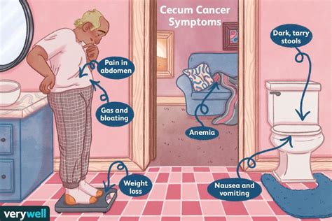 Cecum Cancer: Symptoms, Diagnosis, Treatment, and More