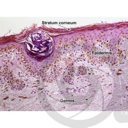 Man. Lentigo simplex. Lentigo. Vertical section. 125X - Nevus - Mammals ...