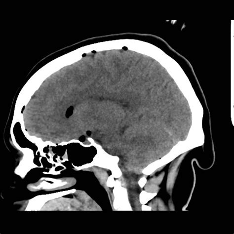 File:Traumatic pneumocranium, cribriform plate fracture and subarachnoid hemorrhage (Radiopaedia ...