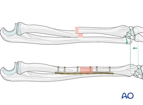 JPeei Clinic — Galeazzi Fracture Causes, Classification and...