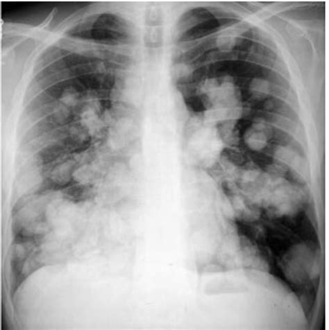 HEALTH DEPARTMENT GUJRAT RADIOLOGY CHEST X-RAY WITH REPORT T.B — Steemit