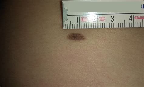 Melanoma Levels Stage 1 To Four Overview