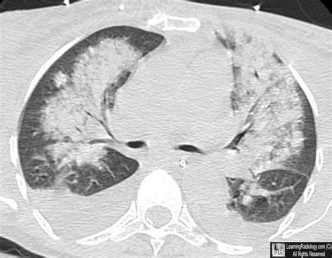 Learning Radiology - Congestive Heart Failure, Pulmonary Edema