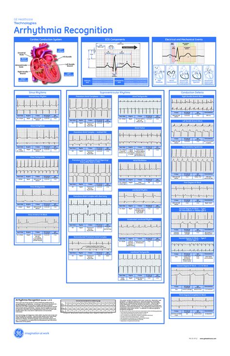 dysrhythmia interpretation | Critical care nursing, Nursing school studying, Nursing school