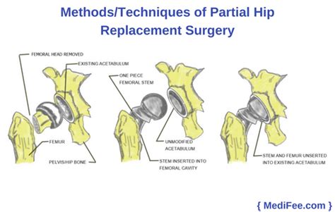 Partial Hip Replacement Surgery: Methods, Risks & Precautions