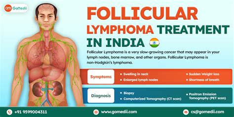 Follicular Lymphoma Symptoms Archives - GoMedii Blog