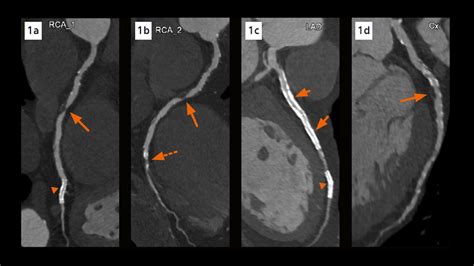 Triple-vessel coronary disease with multiple stents