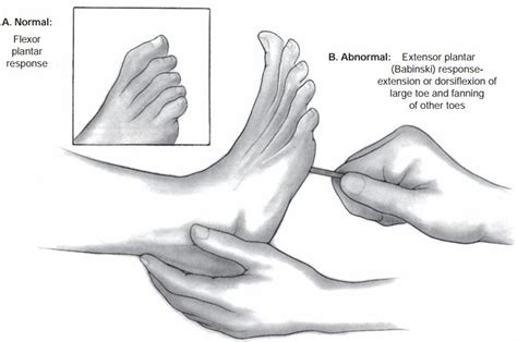 The plantar reflex - Babinski's sign ~ Medicine Hack