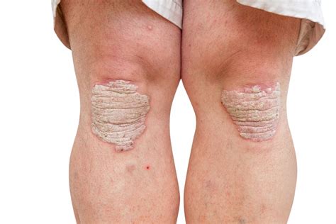 Schuppenflechte (Psoriasis) • Ursache, Symptome & Behandlung