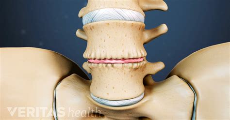 Degenerative Disc Disease Progression over Time