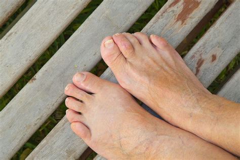 How To Treat A Bunionette On Your Pinky Toe - The Orthopaedic Foot & Ankle Center