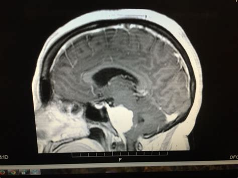 MY petroclival Meningioma Brain Tumor, Health And Wellness, Health Fitness