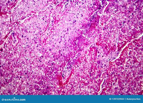 Tuberculosis Granuloma. Langhans Cell Royalty-Free Stock Photography | CartoonDealer.com #93292649