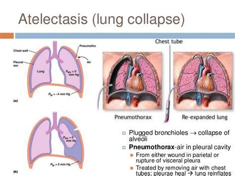 atelectasis | Pediatric nursing, Pediatric nurse practitioner, Nursing ...