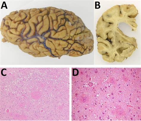 Macroscopic examination of the brain showing A cortical brain atrophy... | Download Scientific ...