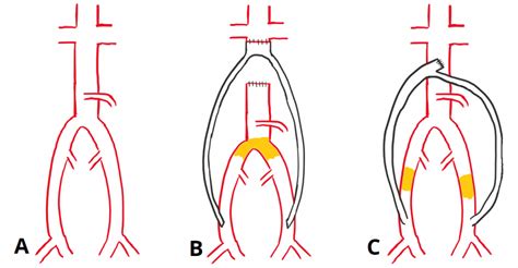 Consent: Arterial Bypass - TeachMeSurgery