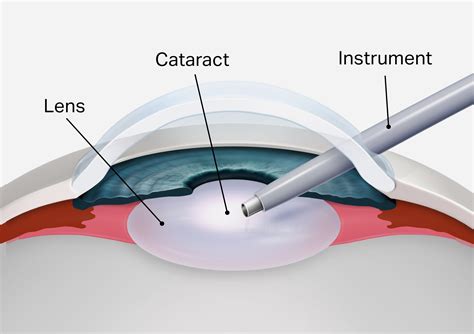 Cataract Surgery Illustrations | medical illustration | Pridgeon Design Group