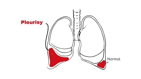 Pleurisy: Symptoms, Causes, and Diagnosis ~ Chest Pain