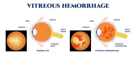 Retinal Hemorrhage Diagram