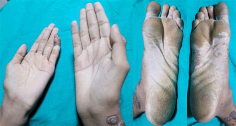 Keratoderma blenorrhagica | BMJ Case Reports