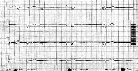 Ventricular Escape Beat ECG