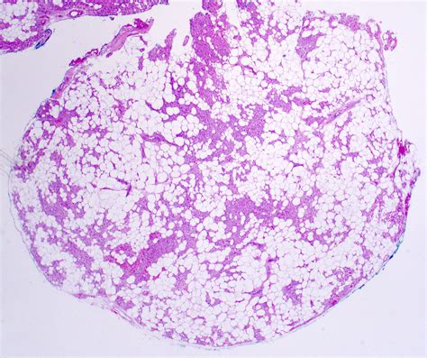 Pathology Outlines - Angiolipoma