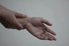 Carpal Tunnel Syndrome Free Stock Photo - Public Domain Pictures